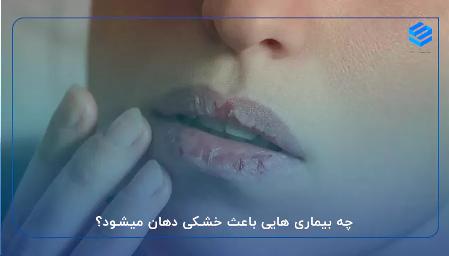چه بیماری هایی باعث خشکی دهان میشود؟