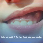 چگونه عفونت دندان را خارج کنیم در خانه