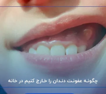 چگونه عفونت دندان را خارج کنیم در خانه