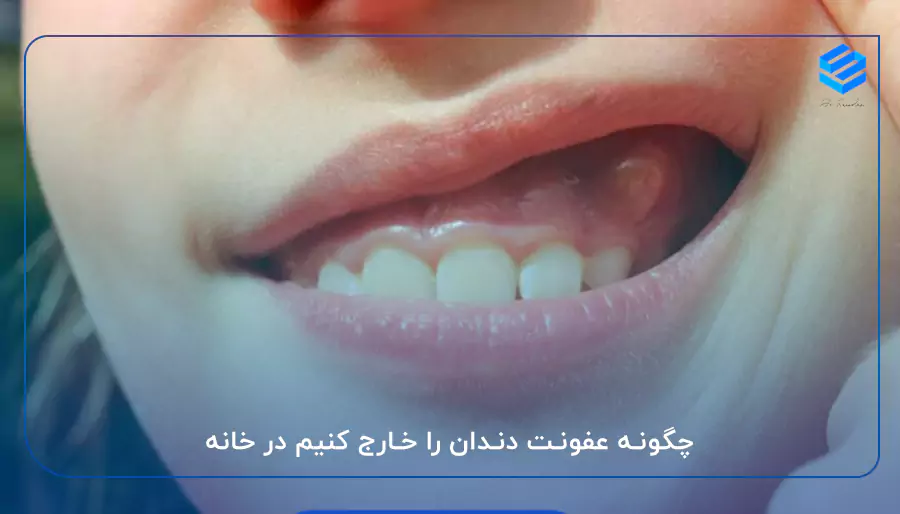 چگونه عفونت دندان را خارج کنیم در خانه