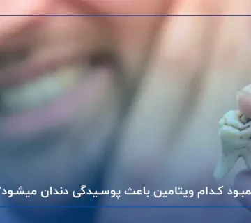 کمبود کدام ویتامین باعث پوسیدگی دندان میشود؟