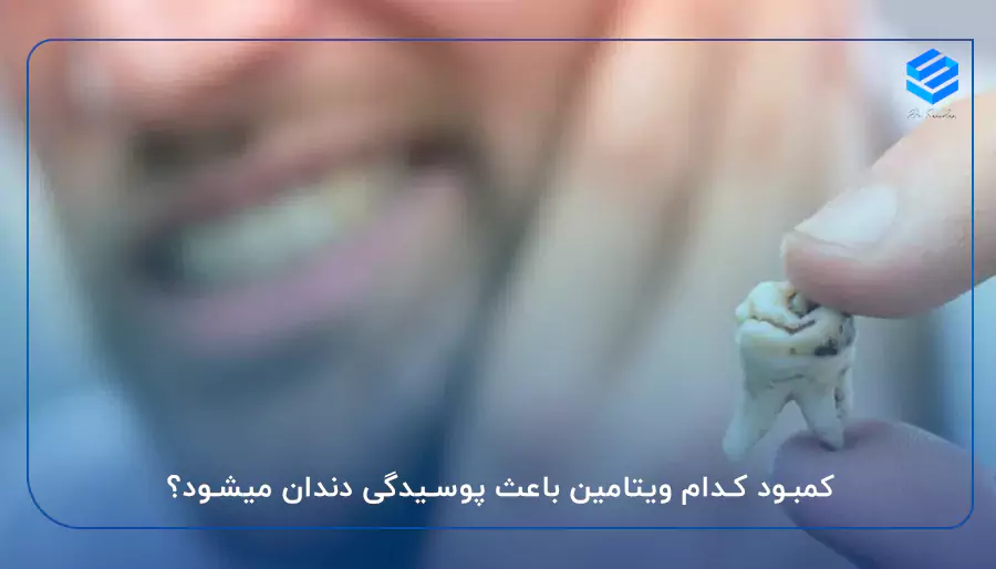 کمبود کدام ویتامین باعث پوسیدگی دندان میشود؟